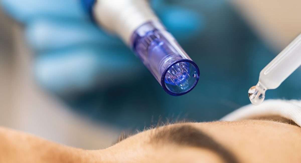 australian-beauty-association-microneedling